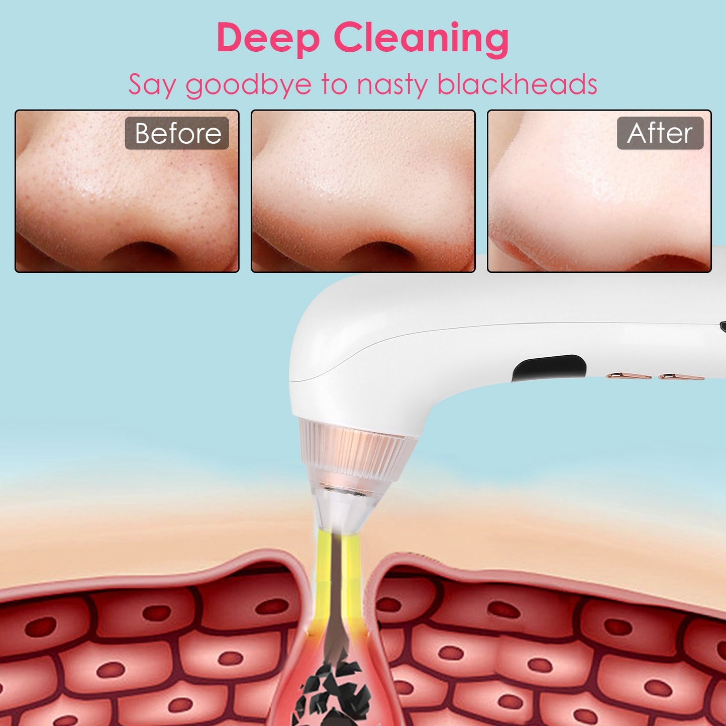 Blackhead Vacuum Remover Acne Remover