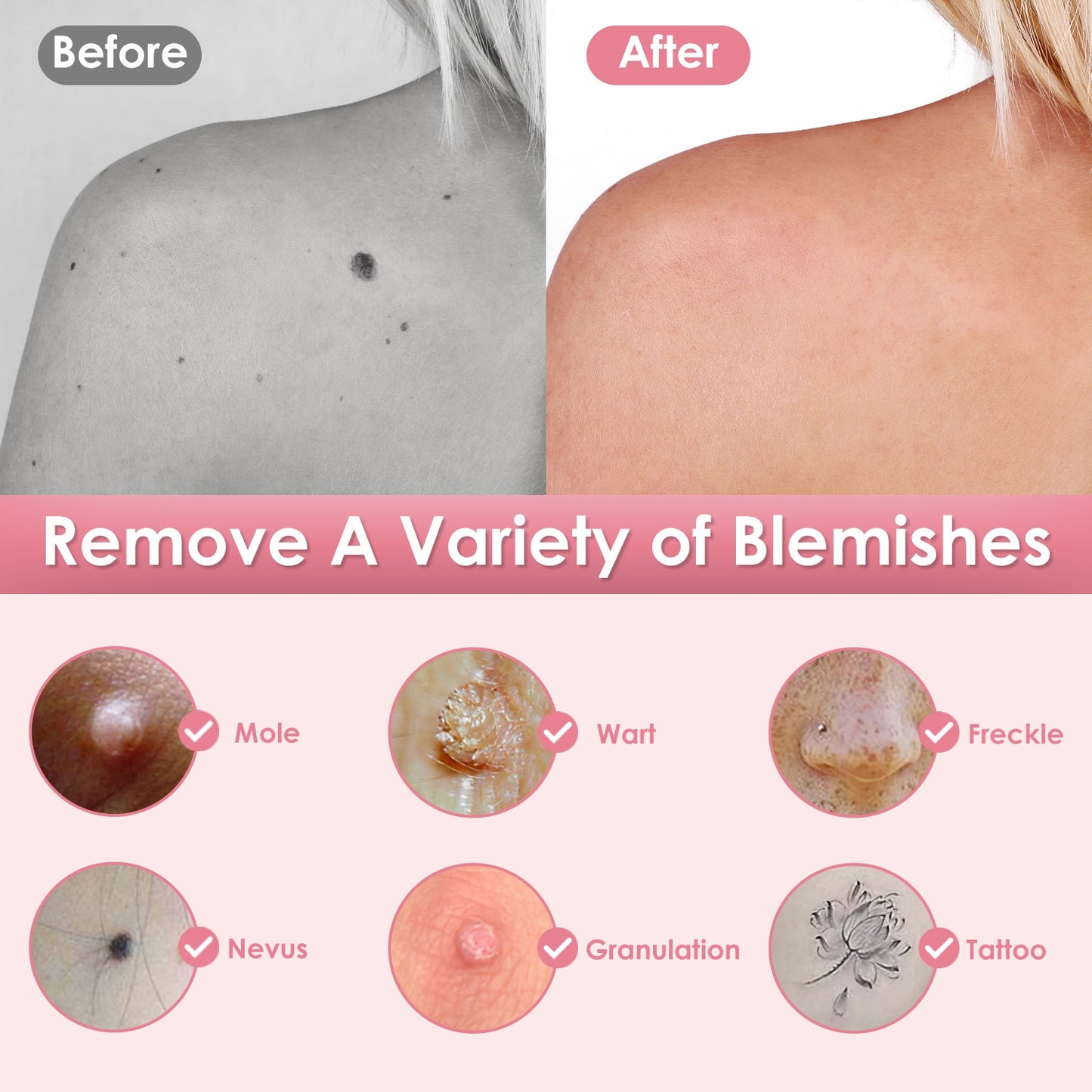 Wart & Freckle Remover with Needles