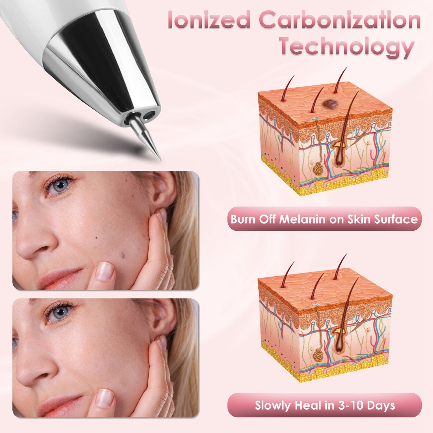 Wart & Freckle Remover with Needles