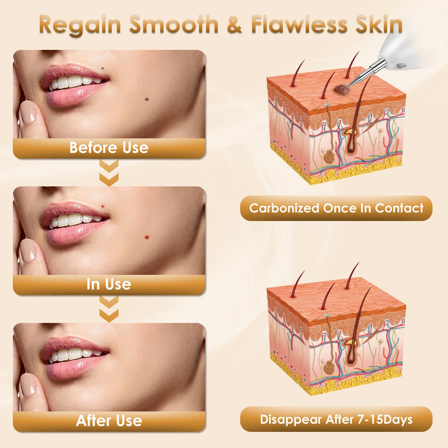 Rechargeable Mole & Wart Remover