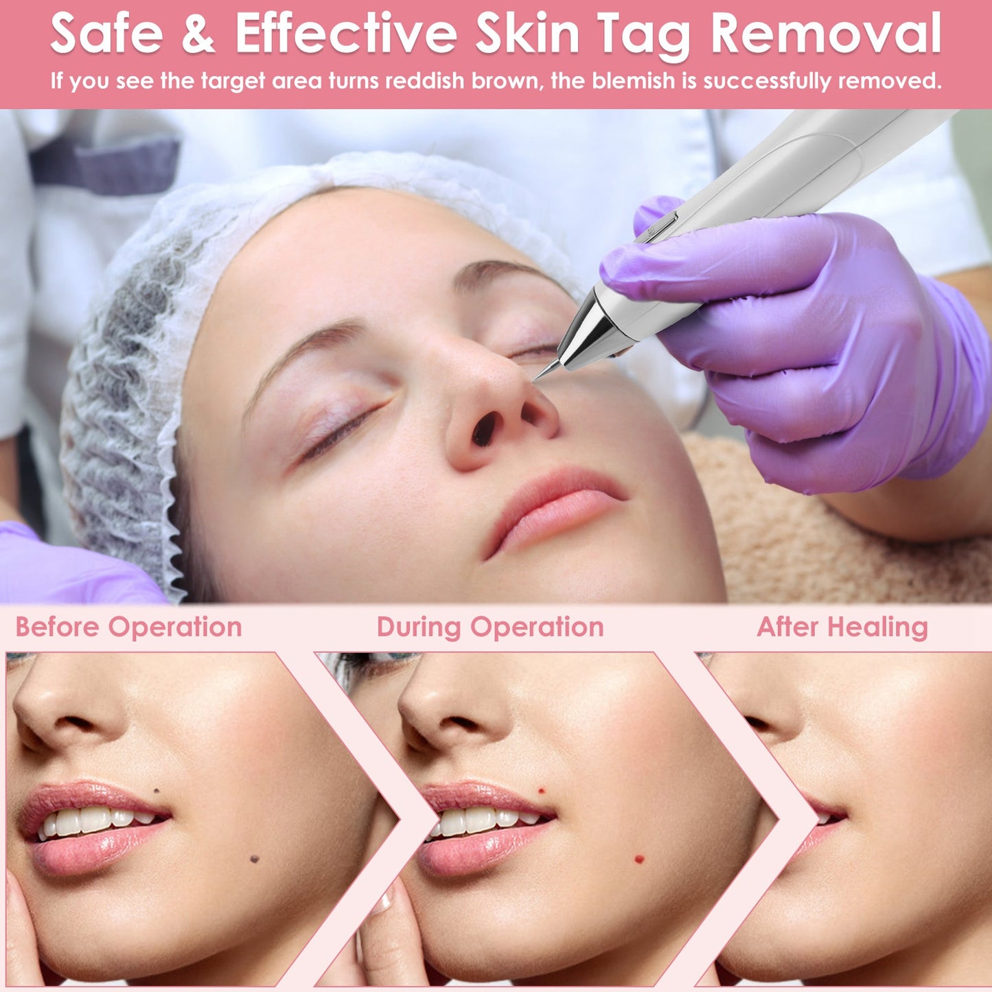 Wart & Freckle Remover with Needles